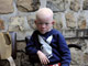 Enfant burundais de la Maison des Albinos à Ruyigi.(Photo : Stéphane Sakutin/AFP)