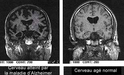 Choroba Alzheimera powoli niszczy komórki mózgowe...© Nasa