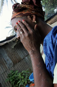 Cette pollution a provoqué la mort d'au moins 16 personnes et l'intoxication de milliers d'autres.&nbsp;Deux ans après l'incident, les symptômes n'ont toujours pas disparu, comme cette&nbsp;Ivoirienne qui souffre de&nbsp;graves problèmes de peau.(Photo : AFP)