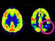 La maladie d’Alzheimer détruit les cellules du cerveau et ce dernier rétrecit.