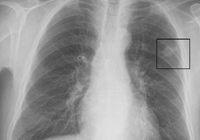 Radiographie d'un thorax montrant une tumeur cancéreuse.GNU Free Documentation License